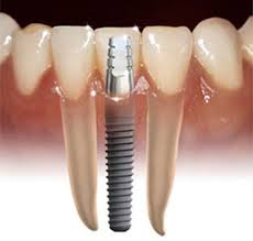 Implant Picture